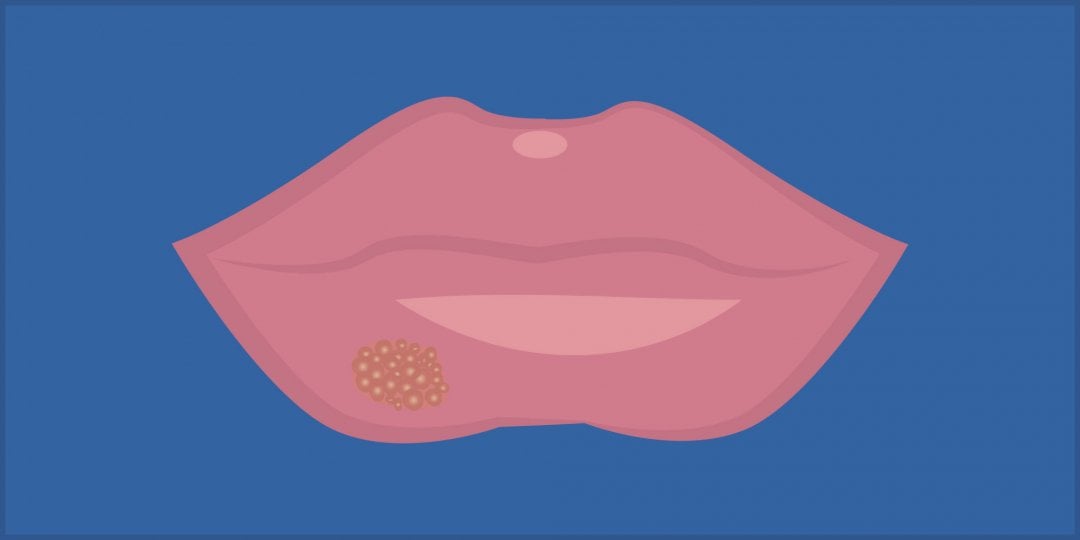 STDs That Show on Your Face